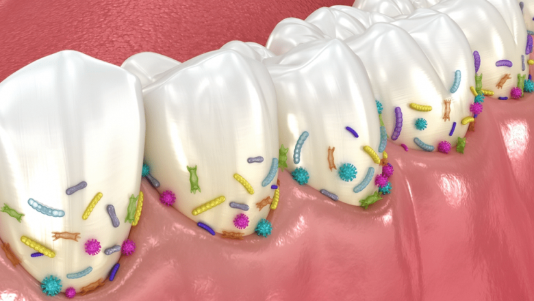 Legătura Inesperată dintre Placa Arterială și Placa Dentară: O Analiză Detaliată