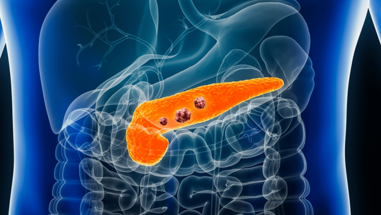 Simptomele Tăcute ale Cancerului Pancreatic: Ce Ar Trebui Să Știi