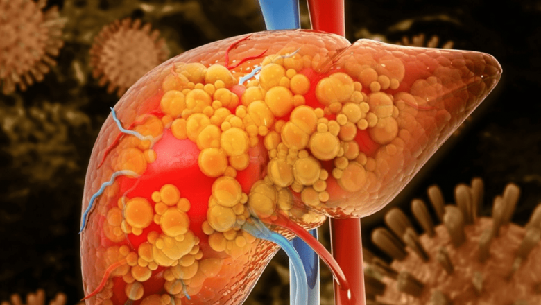Cum să Prevenim Pierderea Funcțiilor Hepatice: Ghid Complet pentru Sănătatea Ficatului