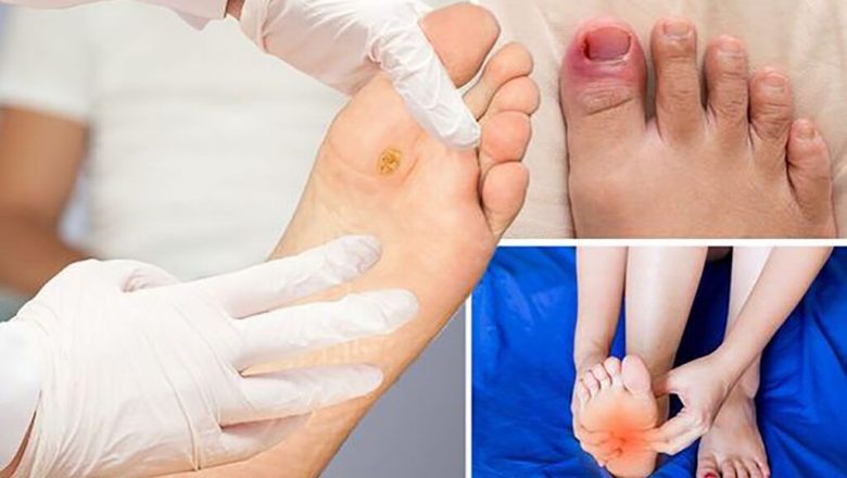 Atenție la durerea de picioare la diabet: Un semnal de alarmă ignorat care poate provoca complicații severe