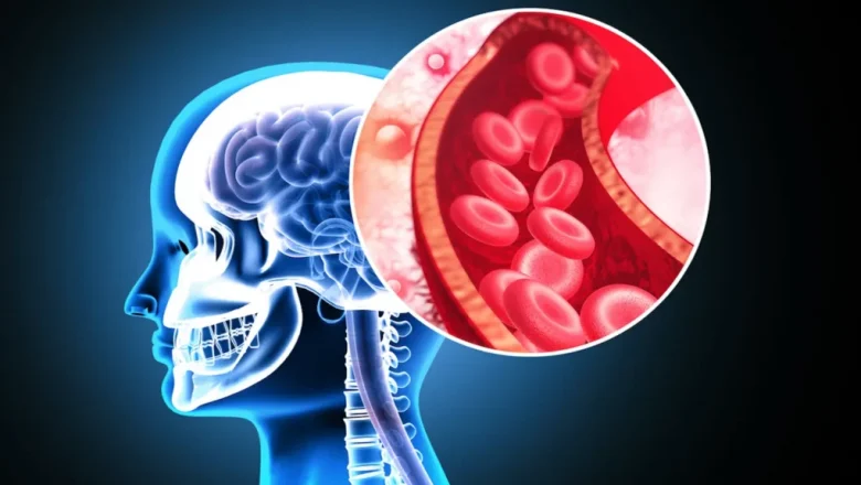 O Nouă Speranță în Recuperarea după AVC: Terapia cu Celule Stem Neuronale