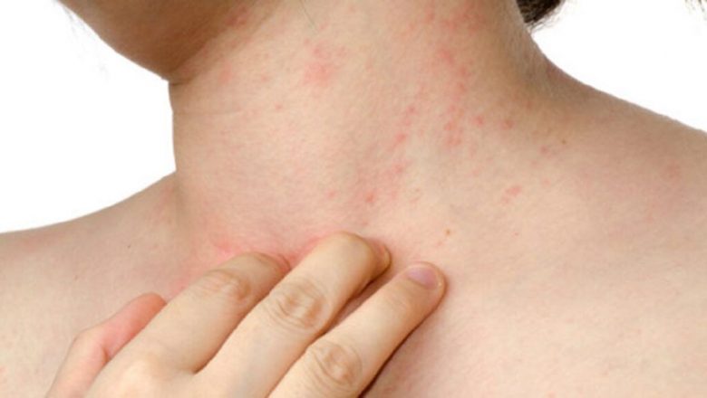 Atenție la semnele pielii: Rezistența la insulină și riscurile ascunse ale diabetului
