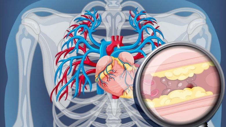 Colesterolul Normal: O Iluzie? Cum Analizele Subevaluate Pot Ascunde Risc de Infarct și AVC
