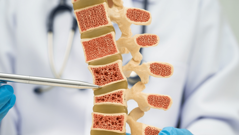 Osteopenia: O Afecțiune Osoasă Silențioasă Care Afectează Aproape 40% Dintre Adulți