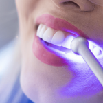 De ce pacienții aleg albirea dentară profesională în detrimentul soluțiilor de acasă: O analiză detaliată