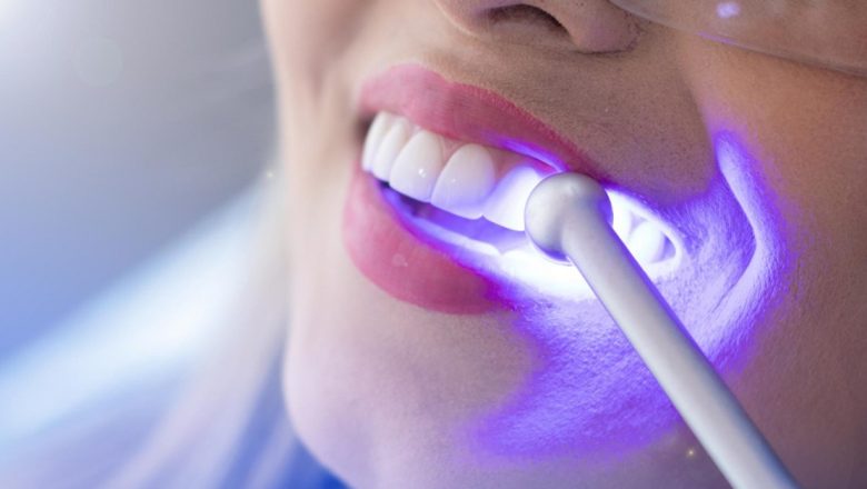 De ce pacienții aleg albirea dentară profesională în detrimentul soluțiilor de acasă: O analiză detaliată