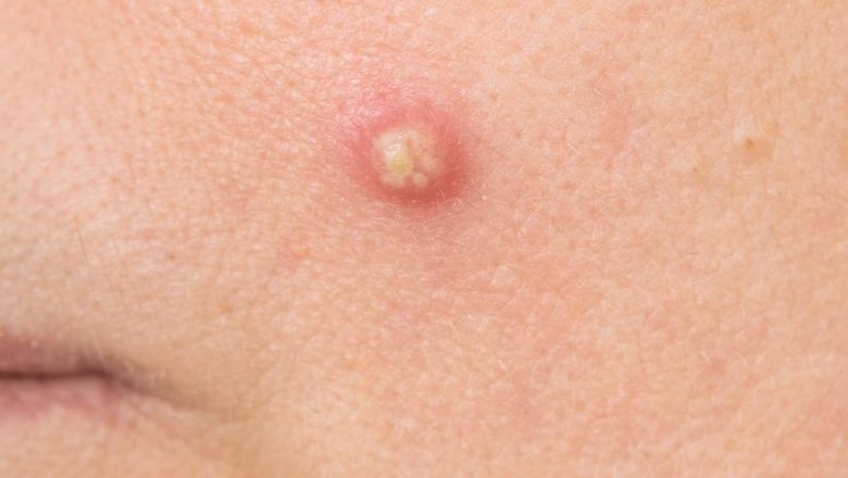 Furunculii: Cauze, Tratament și Remedii Naturale pentru o Vindecare Rapidă