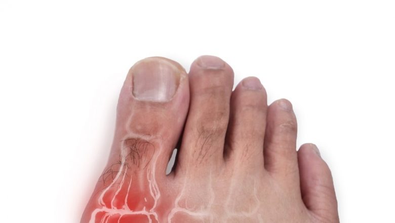 Îți Poți Micșora Monturile de la Picioare în Mod Natural? O Analiză Detaliată a Opțiunilor și Implicațiilor