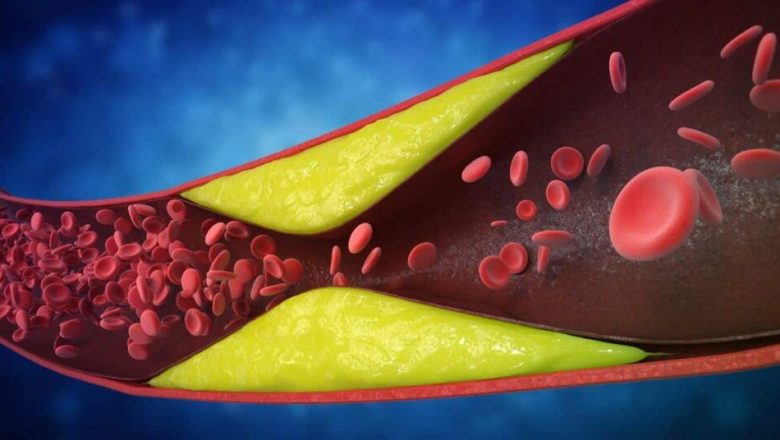 Colesterolul Ascuns: Pericolele Lipoproteinei(a) și Impactul Său Asupra Sănătății Cardiovasculare
