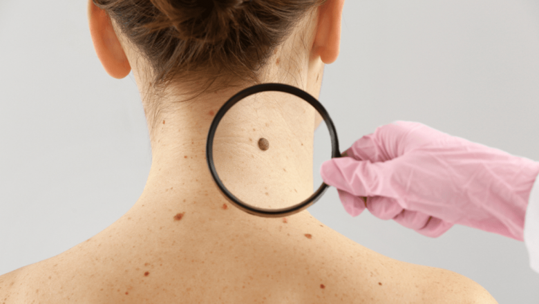 Vitamina B3: O Arma Impotriva Cancerului de Piele