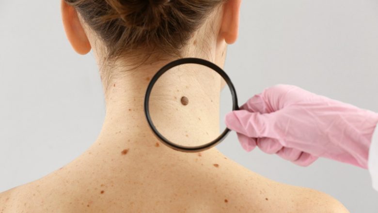 Vitamina B3: O Soluție Promițătoare în Combaterea Cancerului de Piele