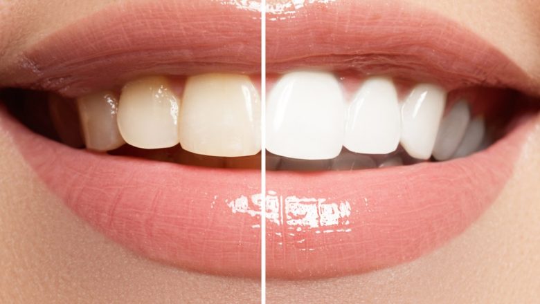 Albirea dinților prin metode tradiționale indiene: Trei ingrediente naturale care transformă igiena orală