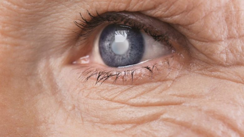 Cataracta în România: O Analiză Detaliată a Exploziei de Cazuri din 2026