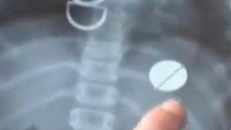 Ce trebuie să faci dacă copilul tău a înghițit un obiect: Ghid complet pentru părinți